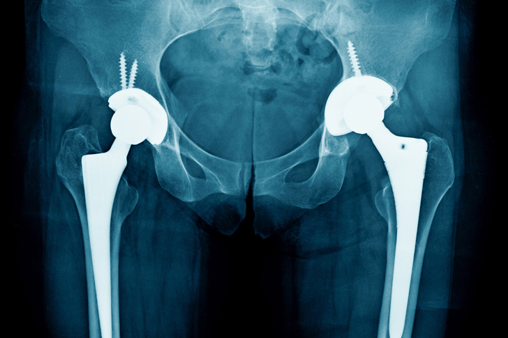 SJH_Website_Hip_XRay_Image.jpg